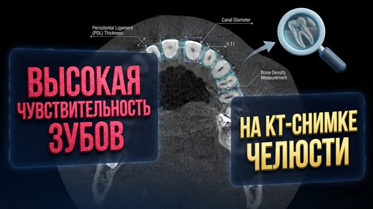 Повысилась ЧУВСТВИТЕЛЬНОСТЬ ЗУБА после пломбирования на РАСШИФРОВКЕ КТ верхней челюсти второе мнение