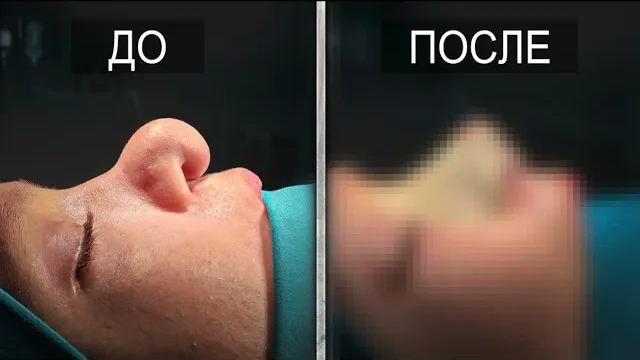 НОВЫЙ НОСИК ДЛЯ ВАРИ. Провели уникальную операцию для девочки из сложной семьи.