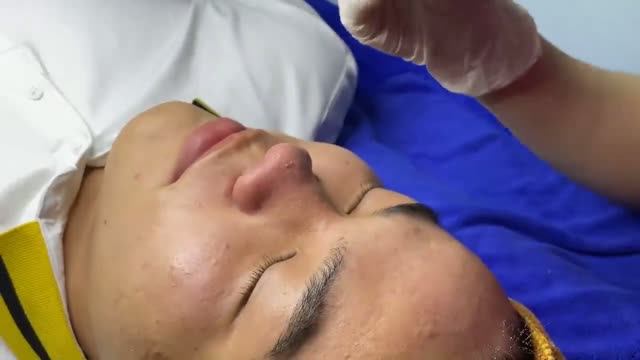 Удаление прыщей и черных точек  качественно