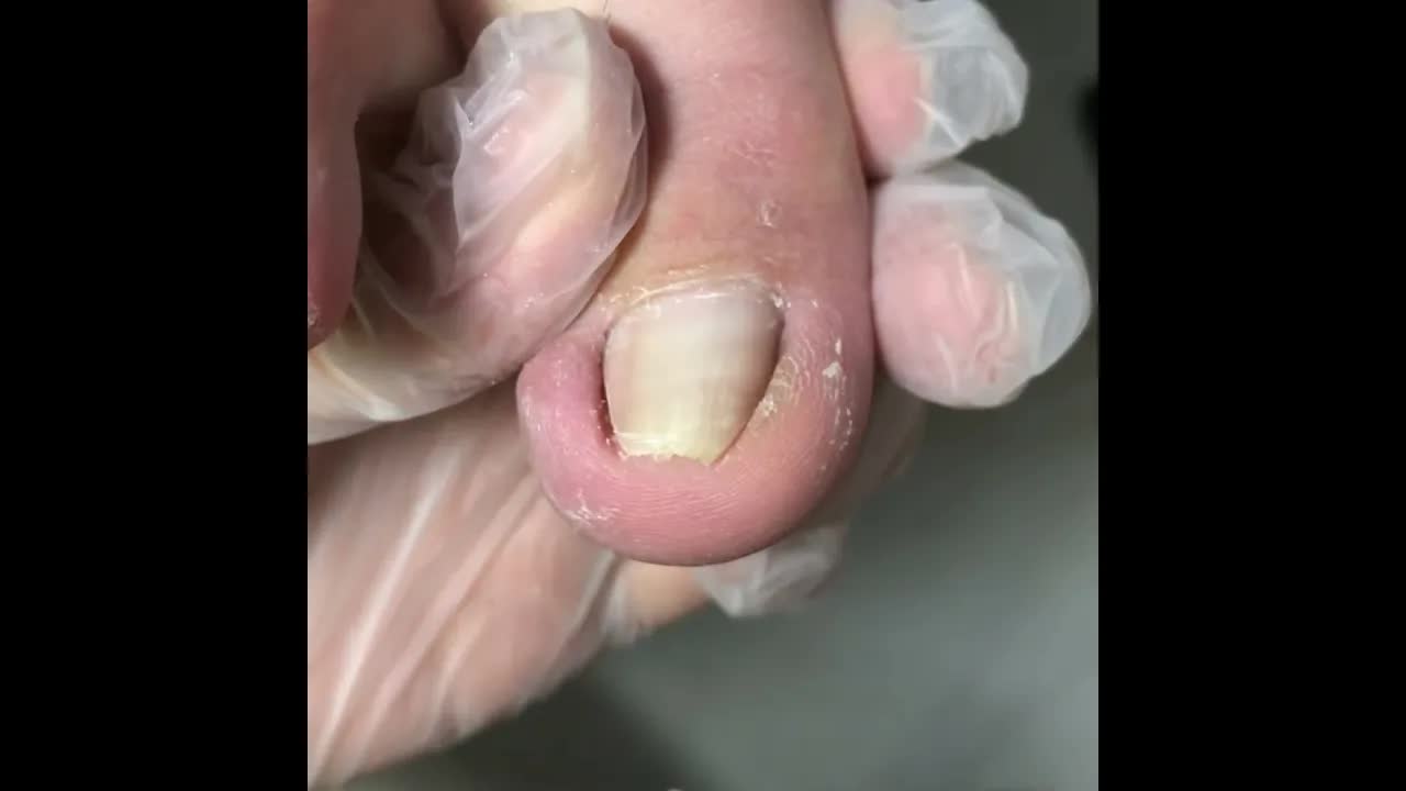 Аккуратно удаляем вросший ноготь. satisfying pedicure