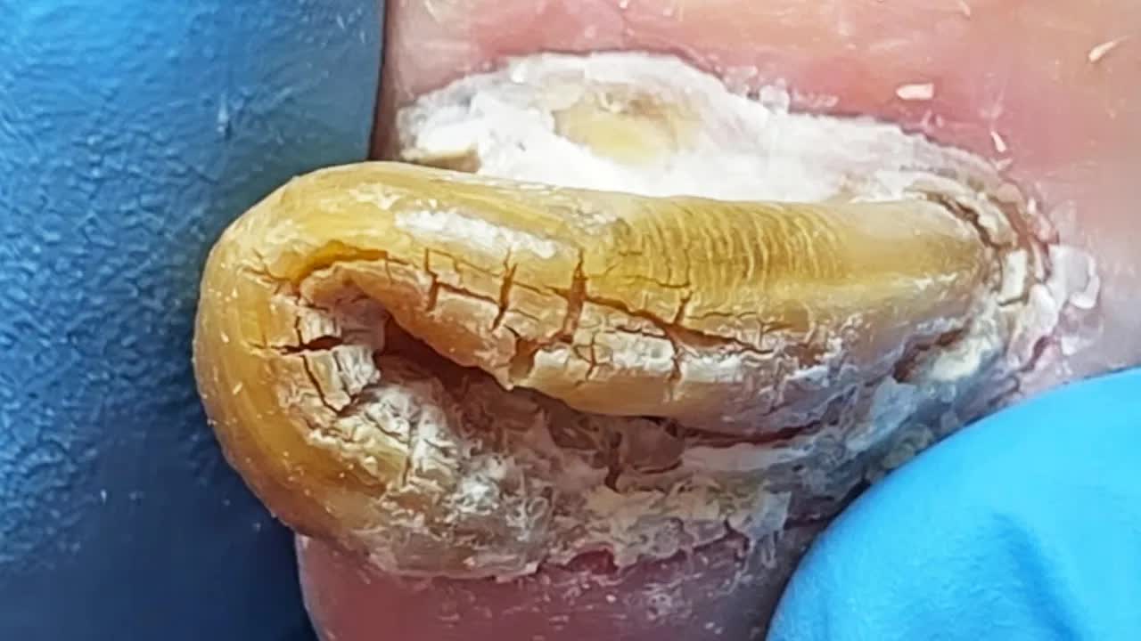 Профессиональный педикюр при толстых грибковых ногтяхPedicure King