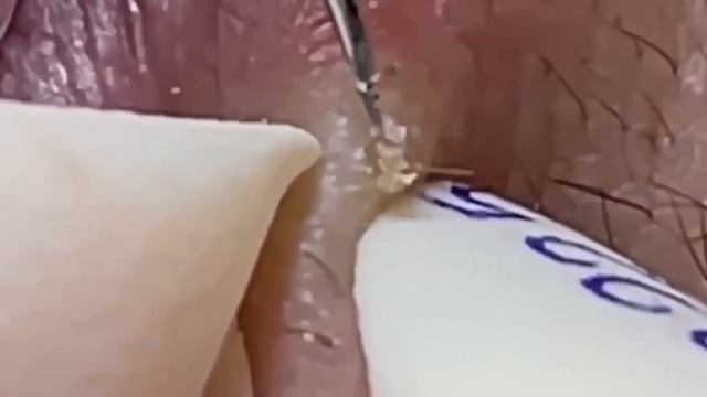 1200 Удаление комедонов угрей и прыщей  глубокое очищение кожи