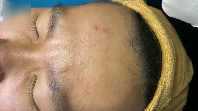 Удаление акне  эффективно и безопасно