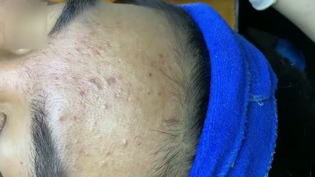 Чистка кожи  удаление акне и профилактика постакне