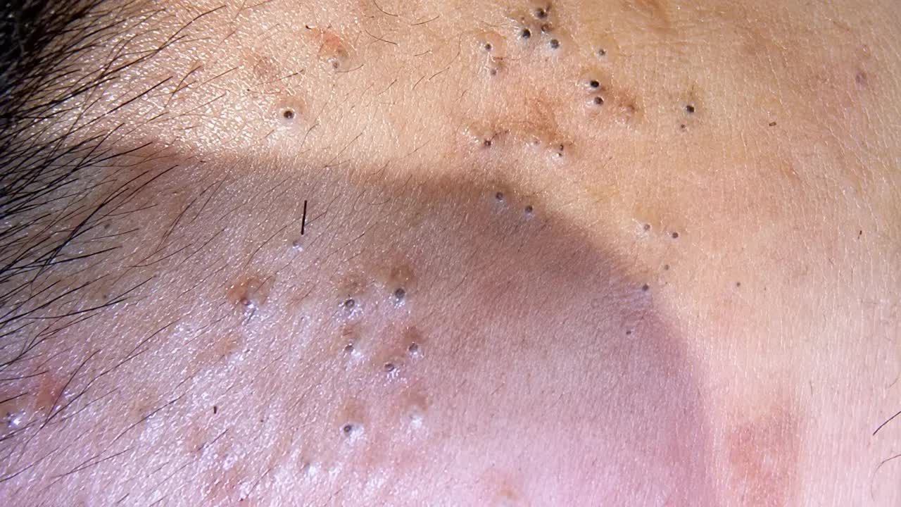 Удаление черных точек  Глубокое очищение пор и корейский уход за кожей