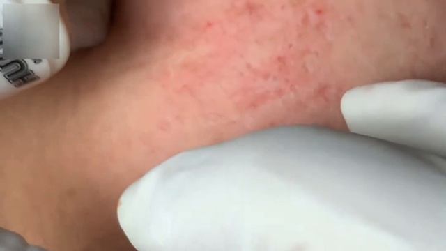 Удаление акне  чистая кожа без усилий