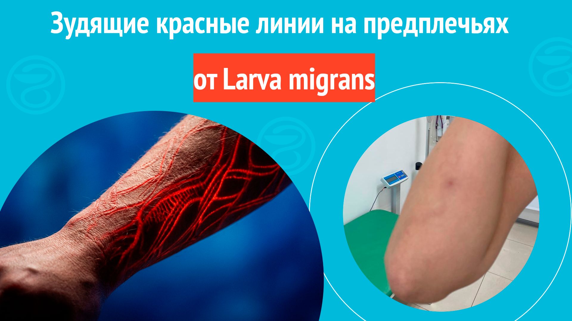 😮 Зудящие красные линии на предплечьях от Larva Migrans. Клинический случай № 1839