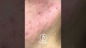 Глубокие прыщи на ногах: удаление
