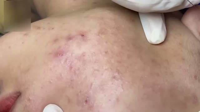Удаление акне  быстрый результат