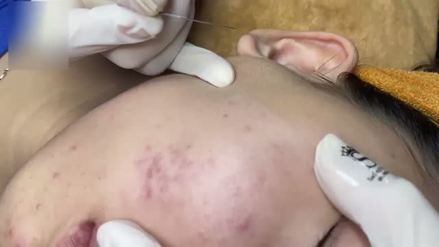 Удаление акне  чистка лица без раздражения