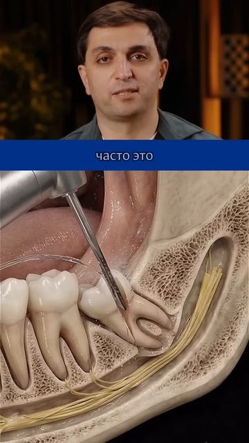 Зачем разрезают зуб мудрости