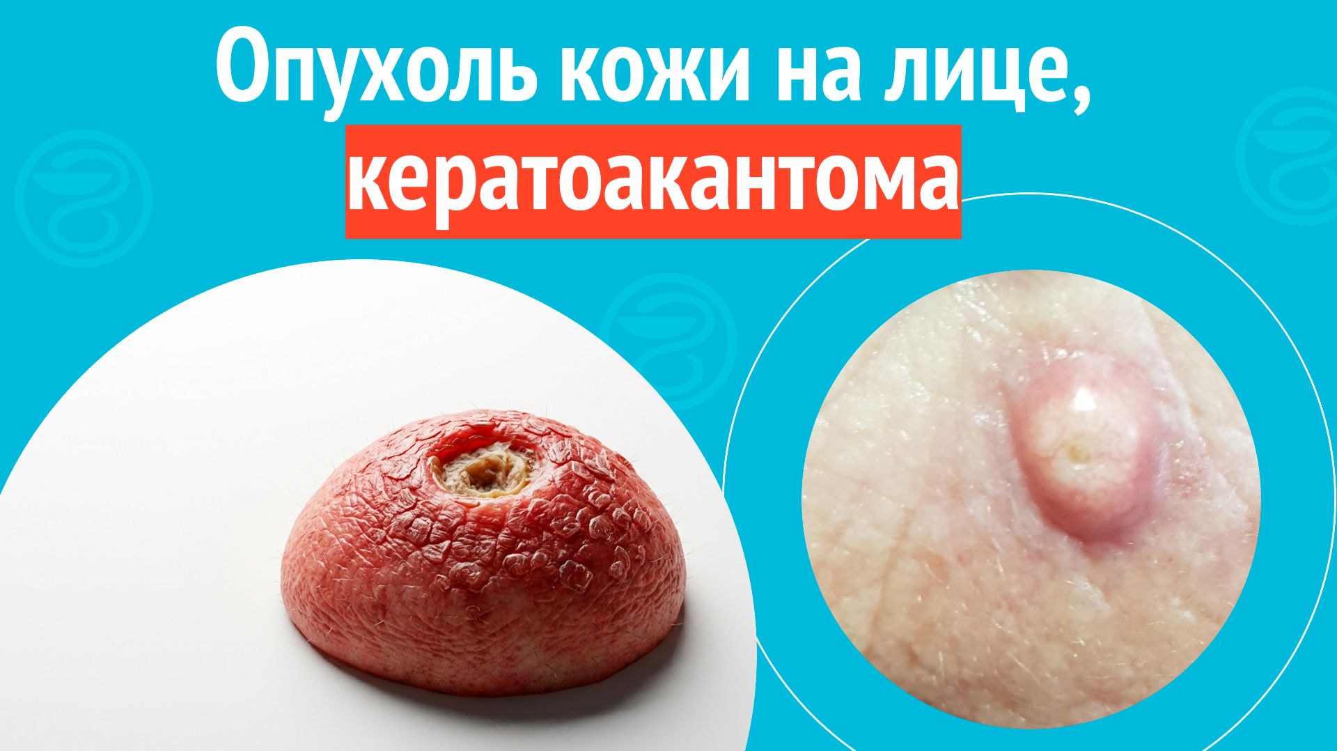 ↪️ Опухоль кожи на лице, кератоакантома. Клинический случай № 1840