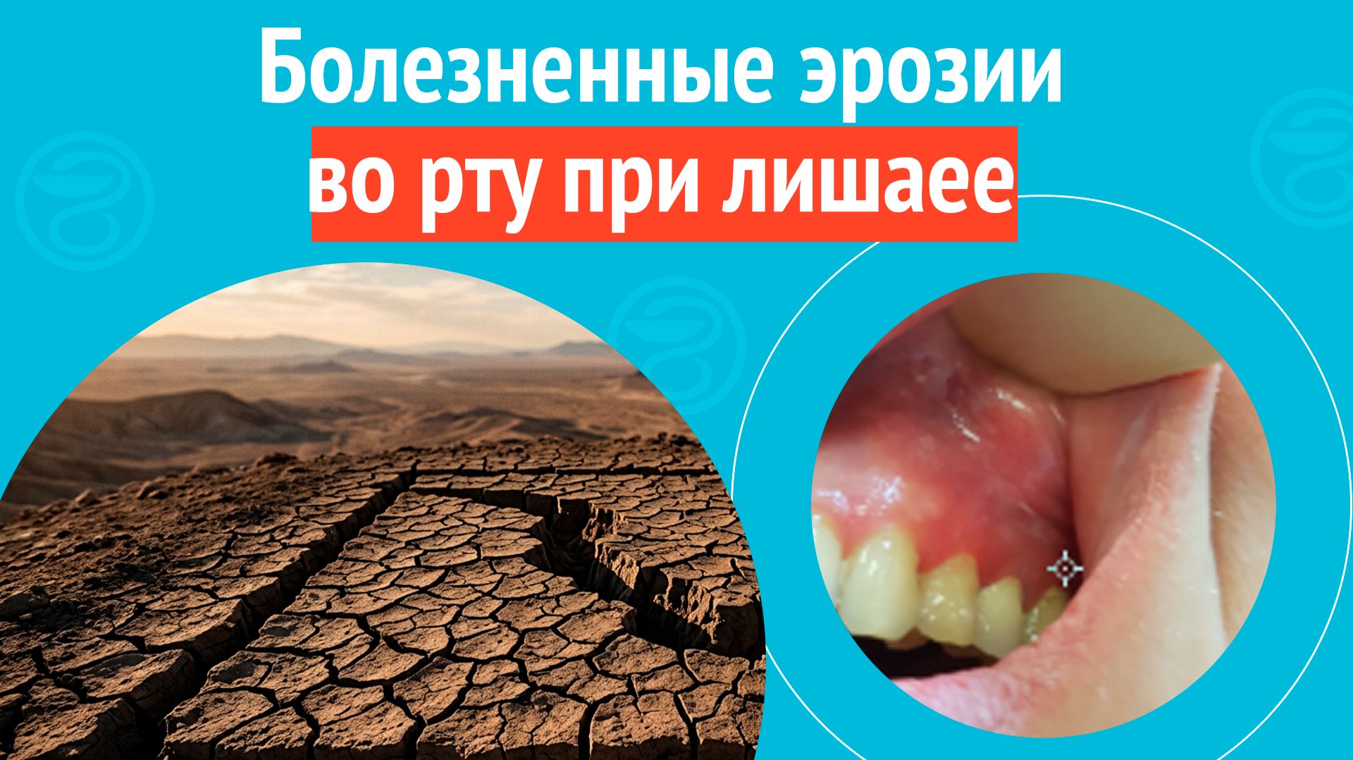 😬 Болезненные эрозии во рту при лишае. Клинический случай № 1841