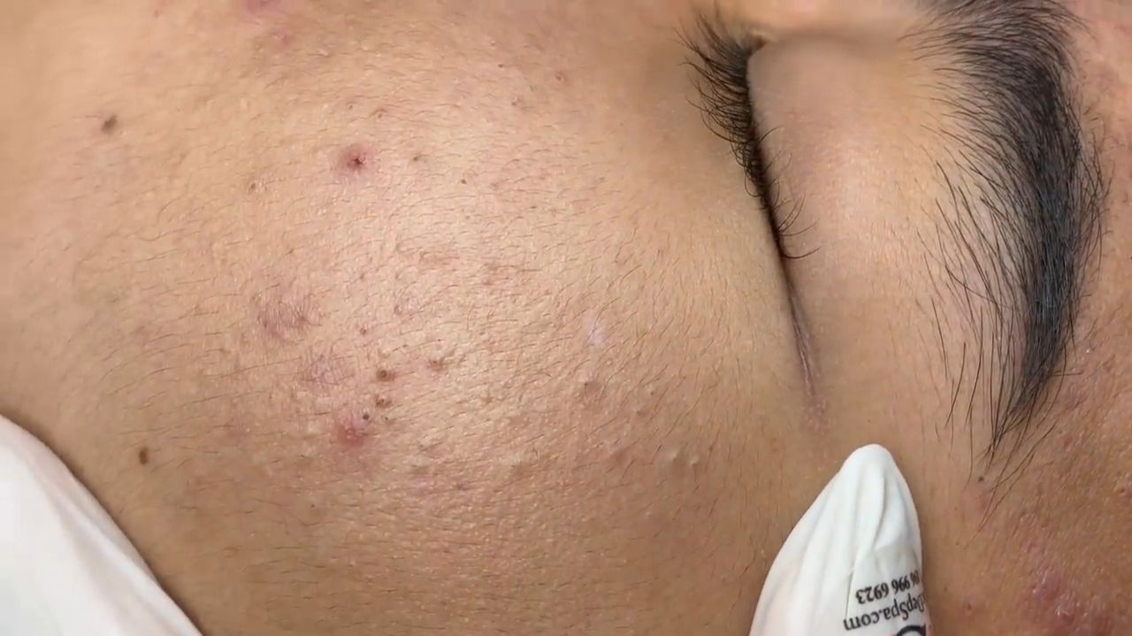 506  Acne collection  АСМР  Relax Spa
