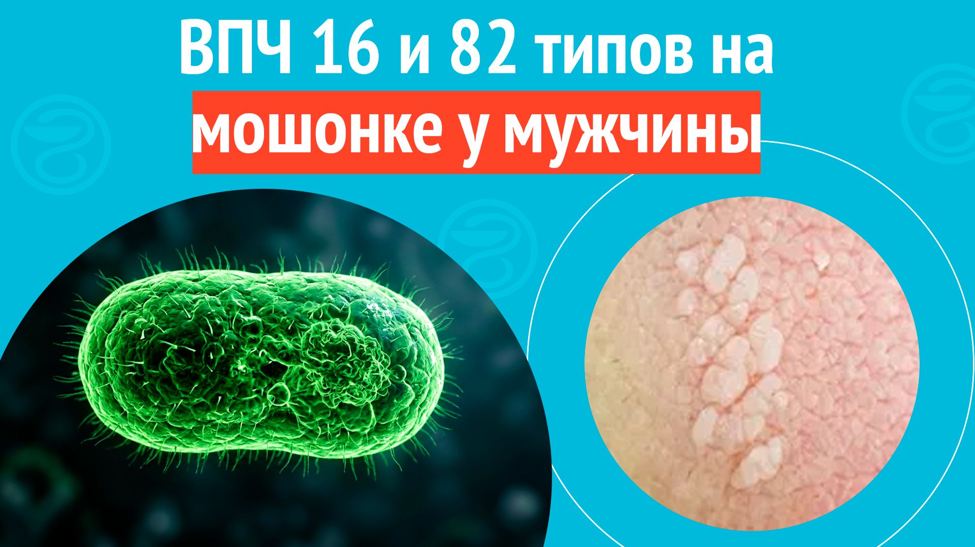 👉 ВПЧ 16 и 82 типов на мошонке у мужчины. Клинический случай № 1842