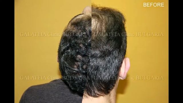 Hair Transplantation-4000 Grafts/Трансплантация на коса-4000 присадки / д-р Зарев