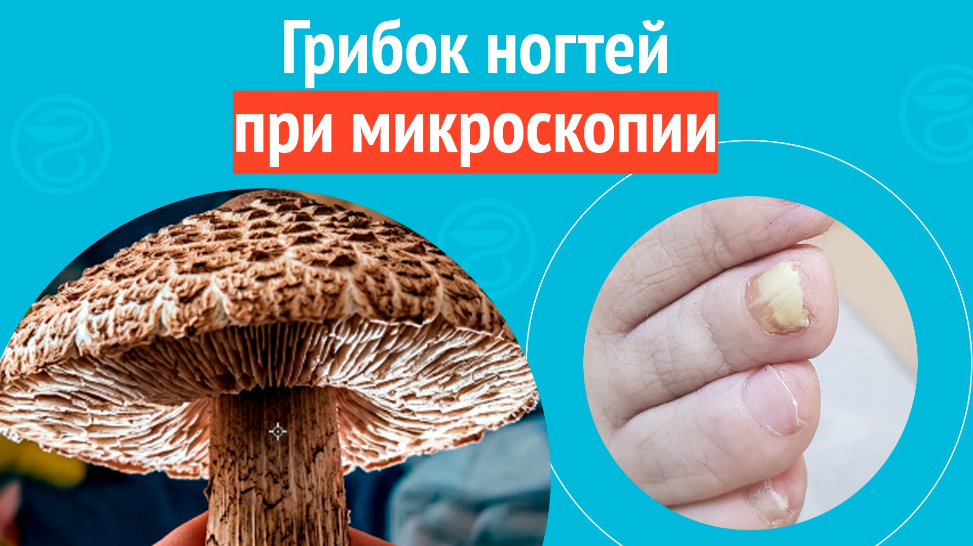 🍄 Грибок ногтей при микроскопии. Клинический случай № 1843