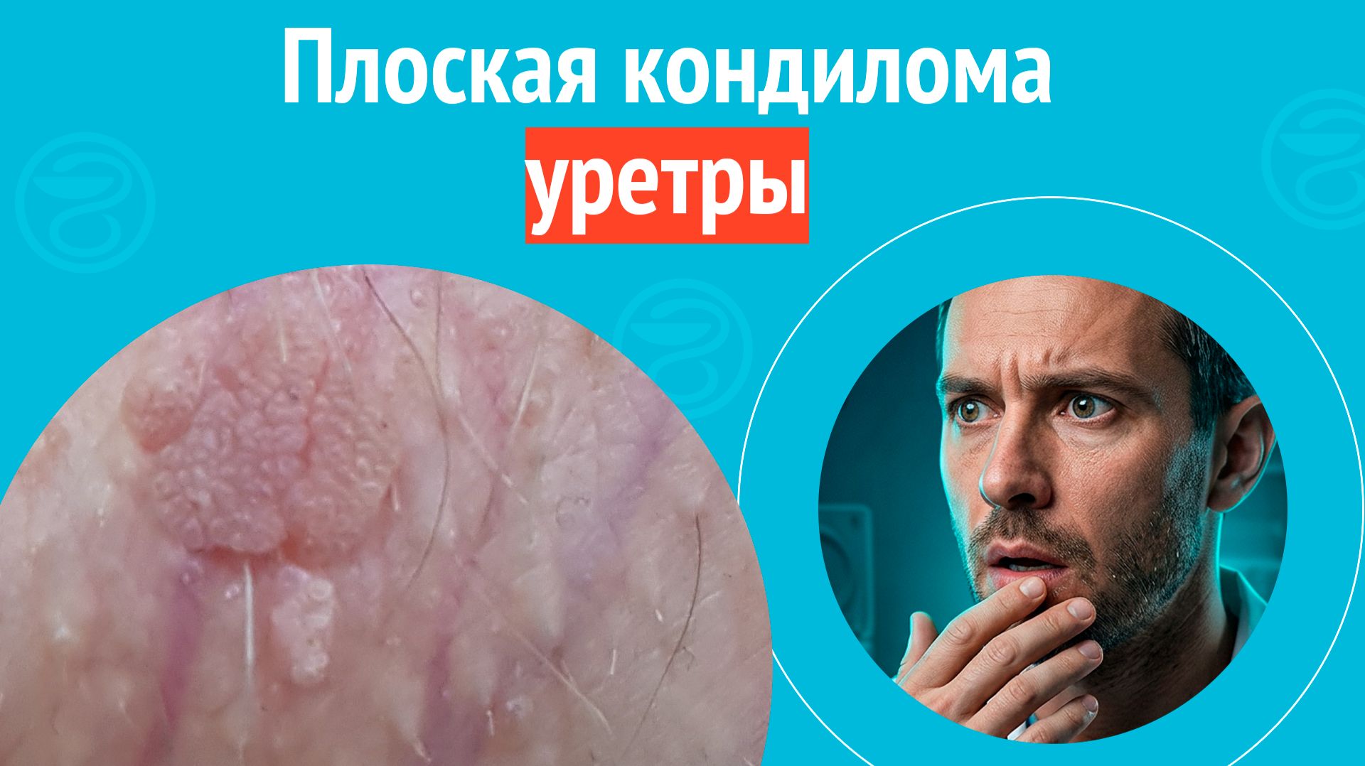 ↪️ Плоская кондилома уретры. Клинический случай № 1845