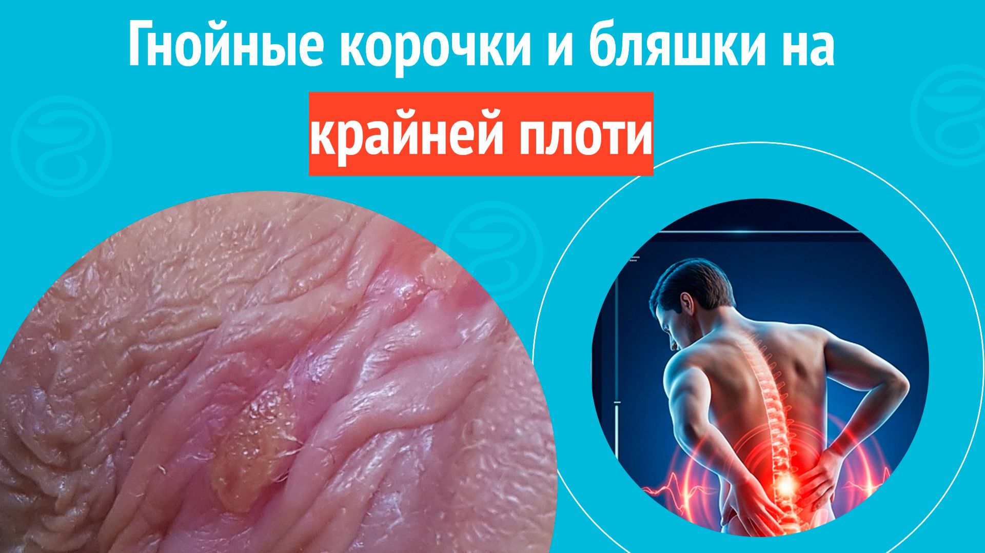 😨 Гнойные корочки и бляшки на крайней плоти. Клинический случай № 1846