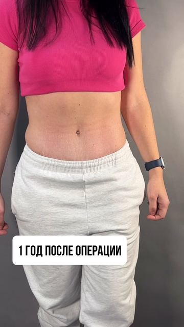 Абдоминопластика.