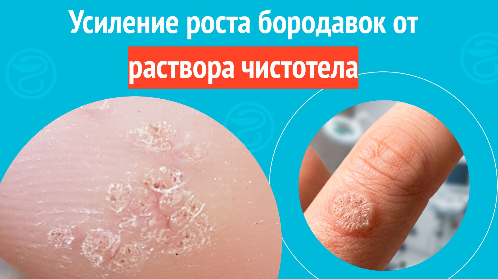 🫤 Усиление роста бородавок от раствора чистотел. Клинический случай № 1848