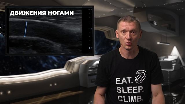 Травма подвешивания или Синдром подвешивания. Смерть при зависании. От чего умирают скалолазы#ПроСМП