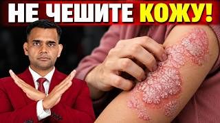 НИКОГДА НЕ ЧЕШИТЕ КОЖУ, ЕСЛИ БЕСПОКОИТ ПСОРИАЗ.
