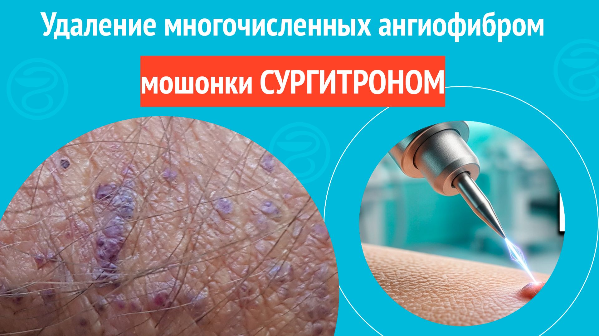 ✅ Удаление многочисленных ангиофибром мошонки СУРГИТРОНОМ. Клинический случай № 1851