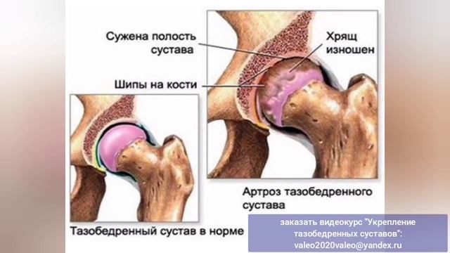 Колени и тазобедренные суставы разваливаются, трудно ходить? Упражнения - обратный путь к здоровью
