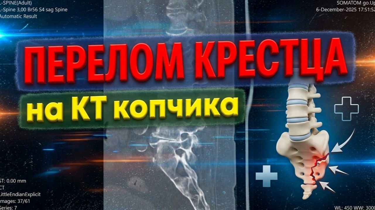 Неконсолидированный ПЕРЕЛОМ КРЕСТЦА остеопороз и формирование ложного сустава на РАСШИФРОВКЕ КТ