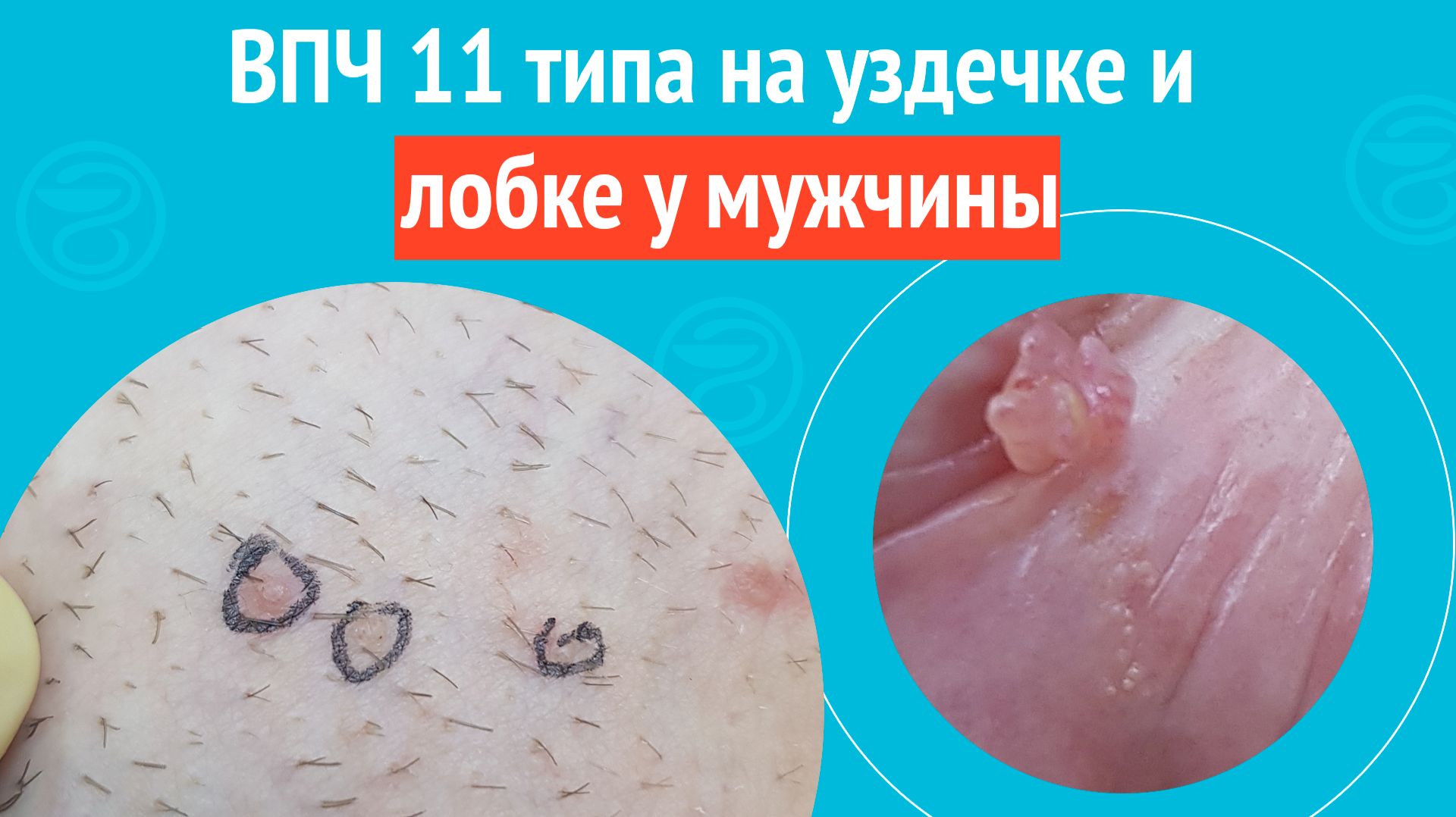 👉 ВПЧ 11 типа на уздечке и лобке у мужчины. Клинический случай № 1853