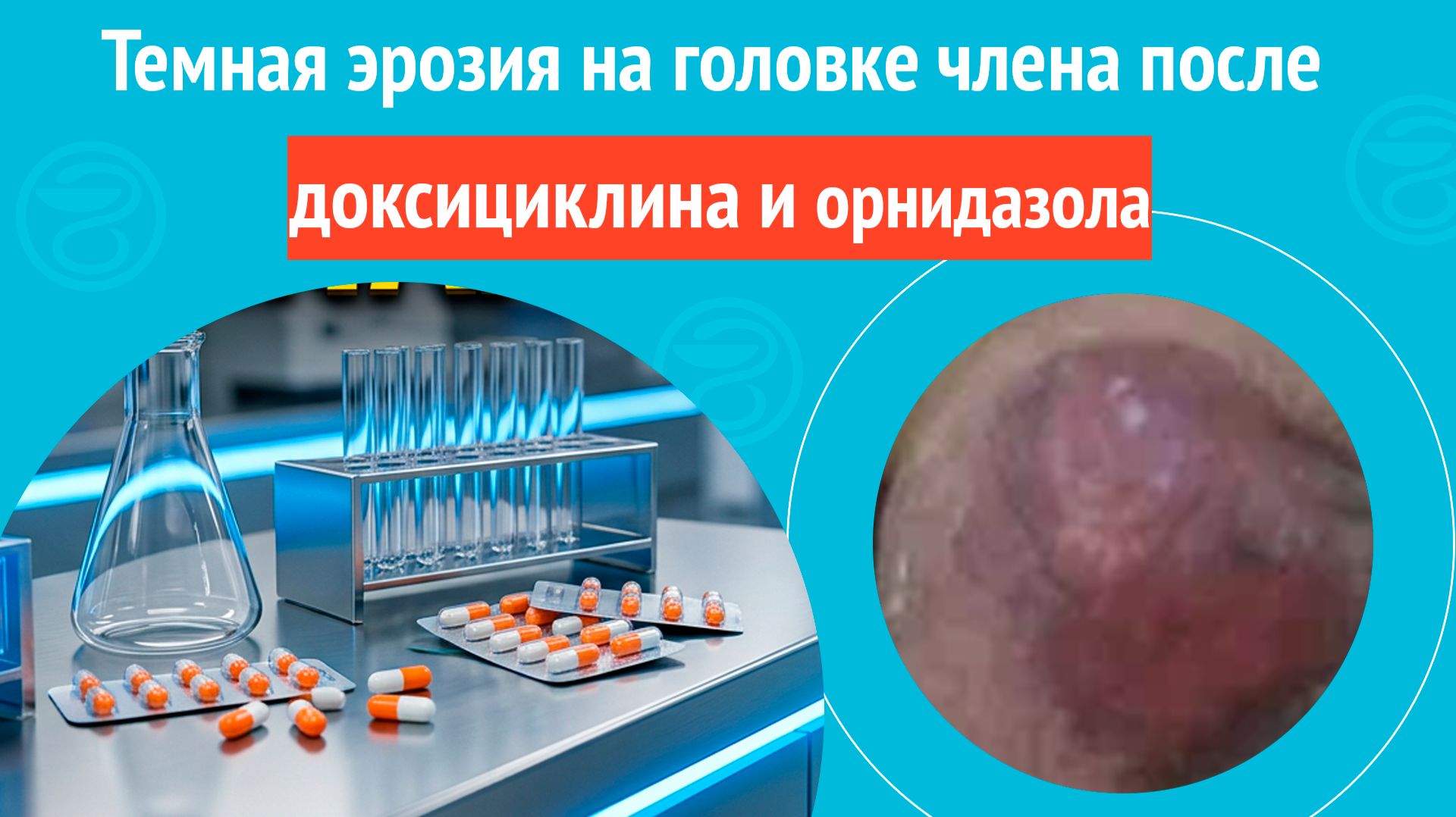 🫩 Темная эрозия на головке члена после доксициклина и орнидазола. Клинический случай № 1852