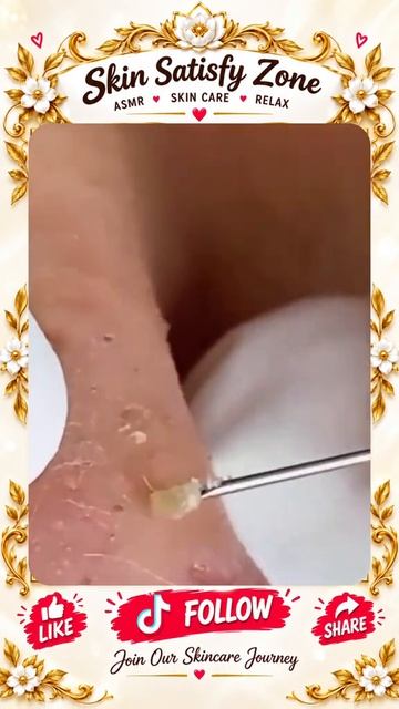 Жирные прыщи.Черные точки.