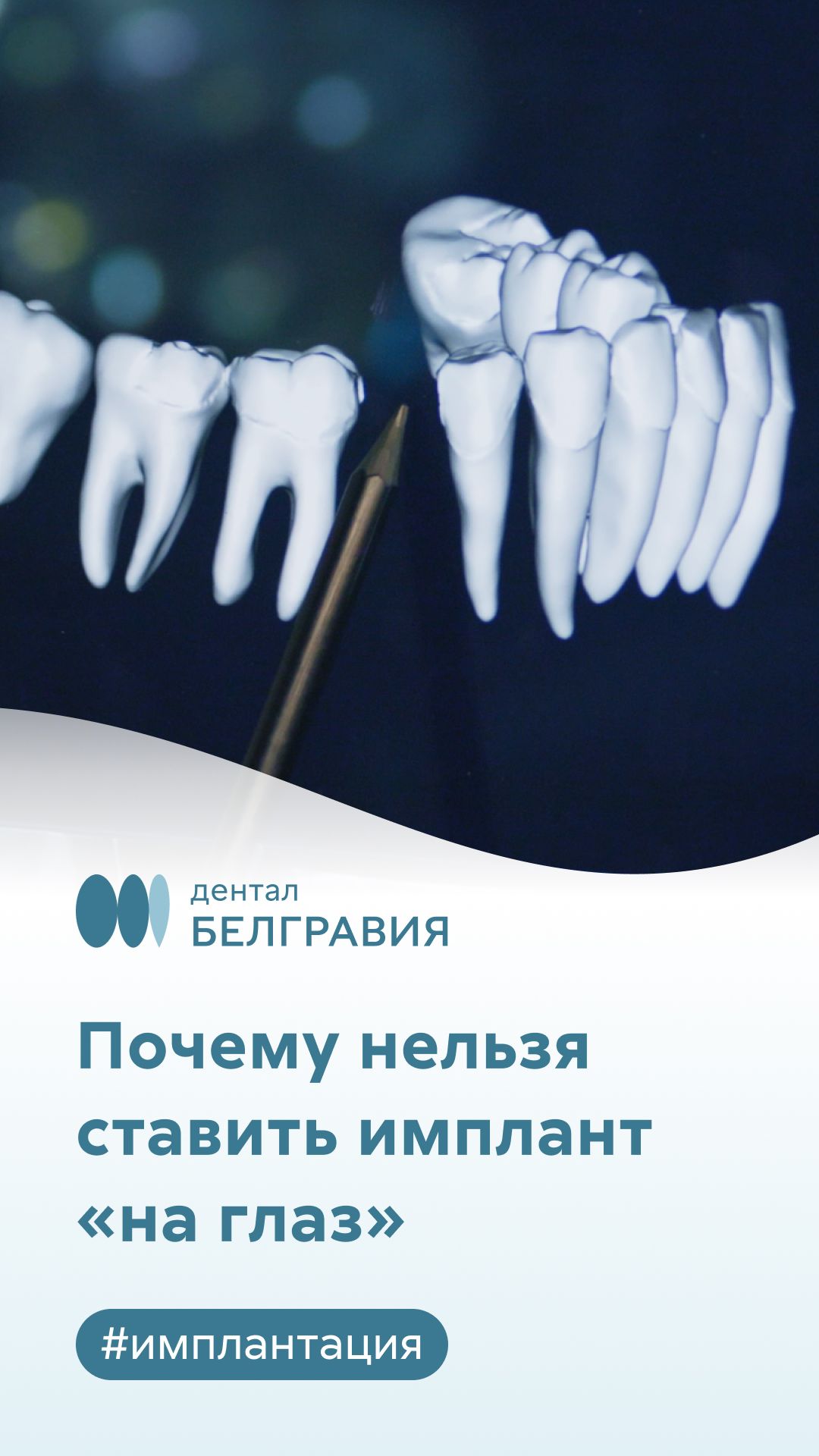 Как правильно ставить имплант? Секрет точного планирования