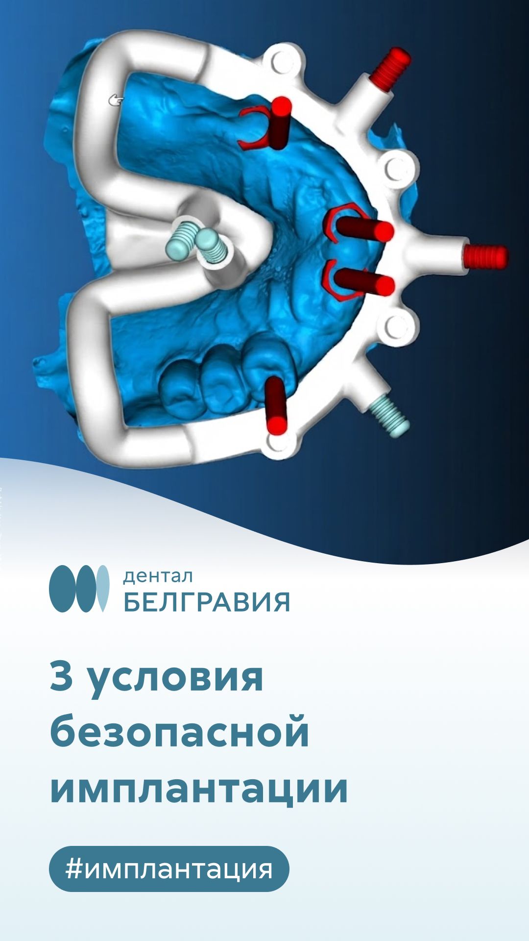 3 главных условия безопасной имплантации зубов