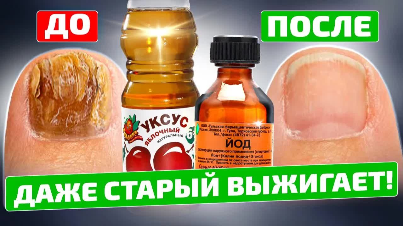 Грибок ногтей  Рецепт из старой газеты против аптеки  йод и яблочный уксус