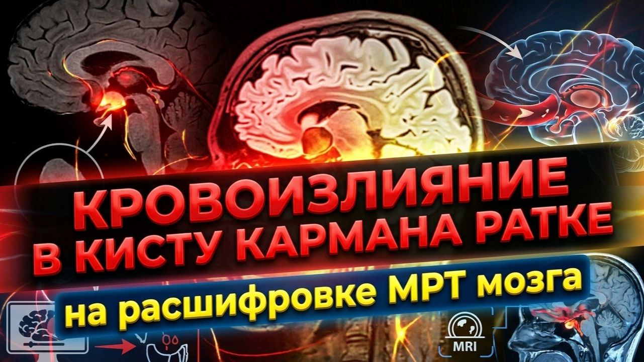 ЭКТОПИЯ миндалин мозжечка и КРОВОИЗЛИЯНИЕ мозга в кисту кармана Ратке на РАСШИФРОВКЕ МРТ головы