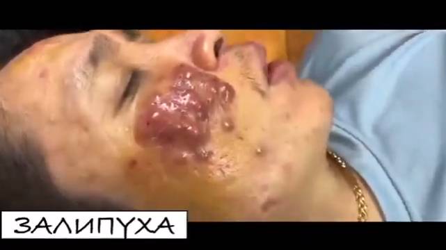ПРЫЩИ ВЫДАВЛИВАНИЕ. ВЫДАВЛИВАНИЕ ПРЫЩЕЙ. ВЫДАВЛИВАНИЕ БЕЛЫХ ПРЫЩЕЙ НА ЛИЦЕ. прыщи acne asmr