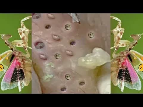 Relax squeezing out blackheads 22 Черные точки