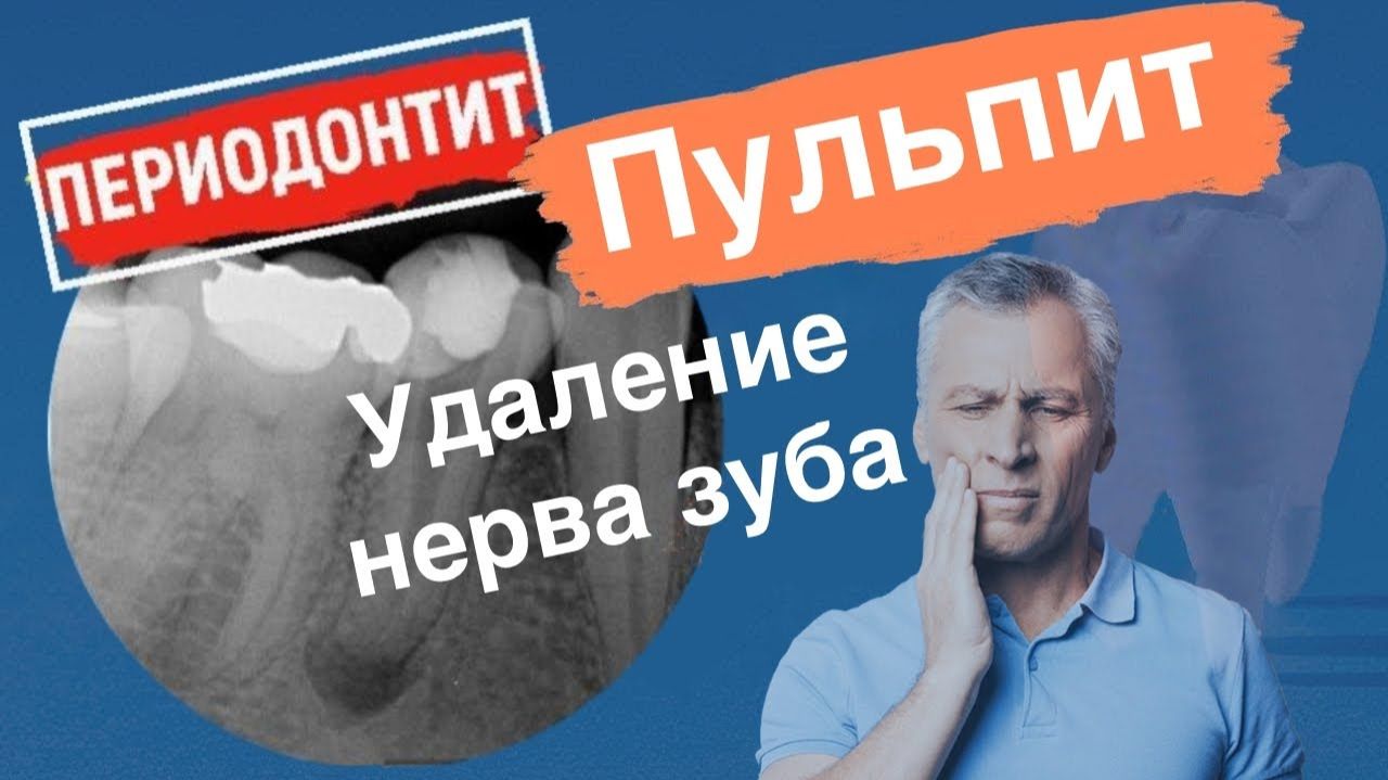 Может ли зуб без нерва считаться здоровым?