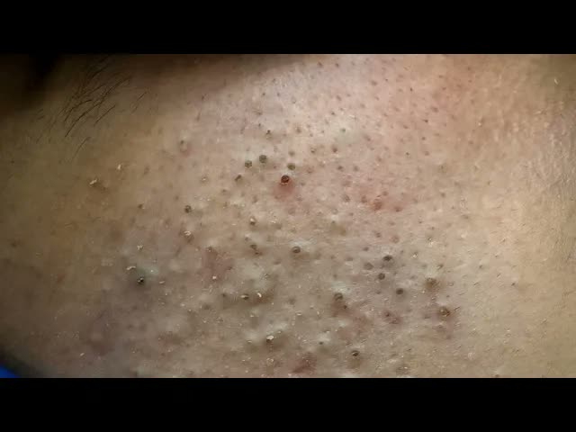 Техники глубокой чистки акне  поры прорываются как никогда ранее  Секреты сияющей кожи