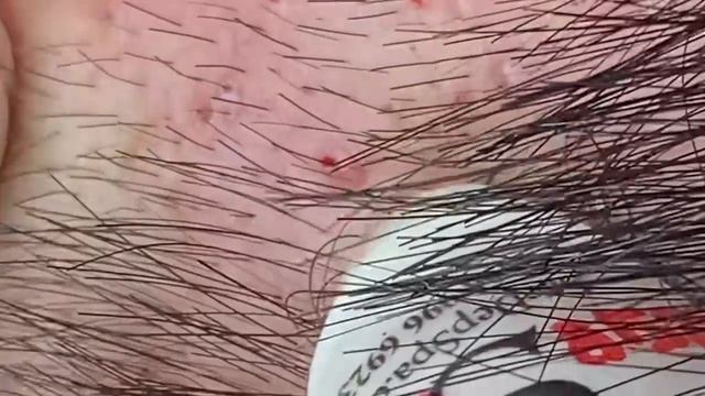 Выдавливание прыщей угрей черных точек и камедонов 845