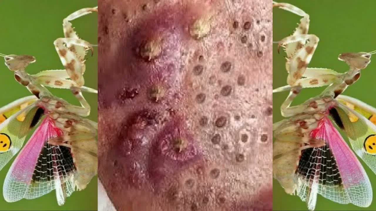 Relax squeezing out blackheads 41 Черные точки