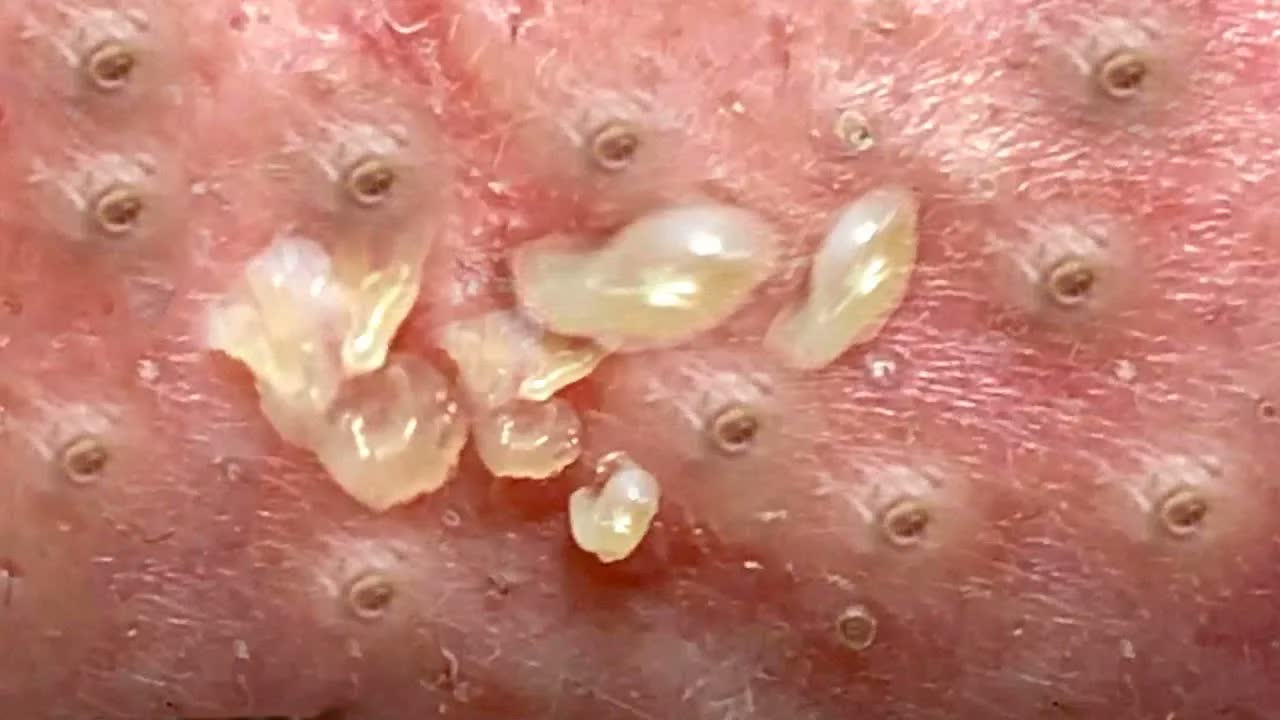 Relax squeezing out blackheads 42 Черные точки