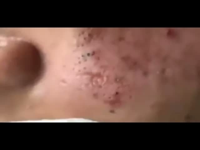 Relax squeezing out blackheads 16 Черные точки