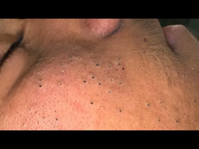 Единственное видео об удалении чёрных точек которое вам нужно