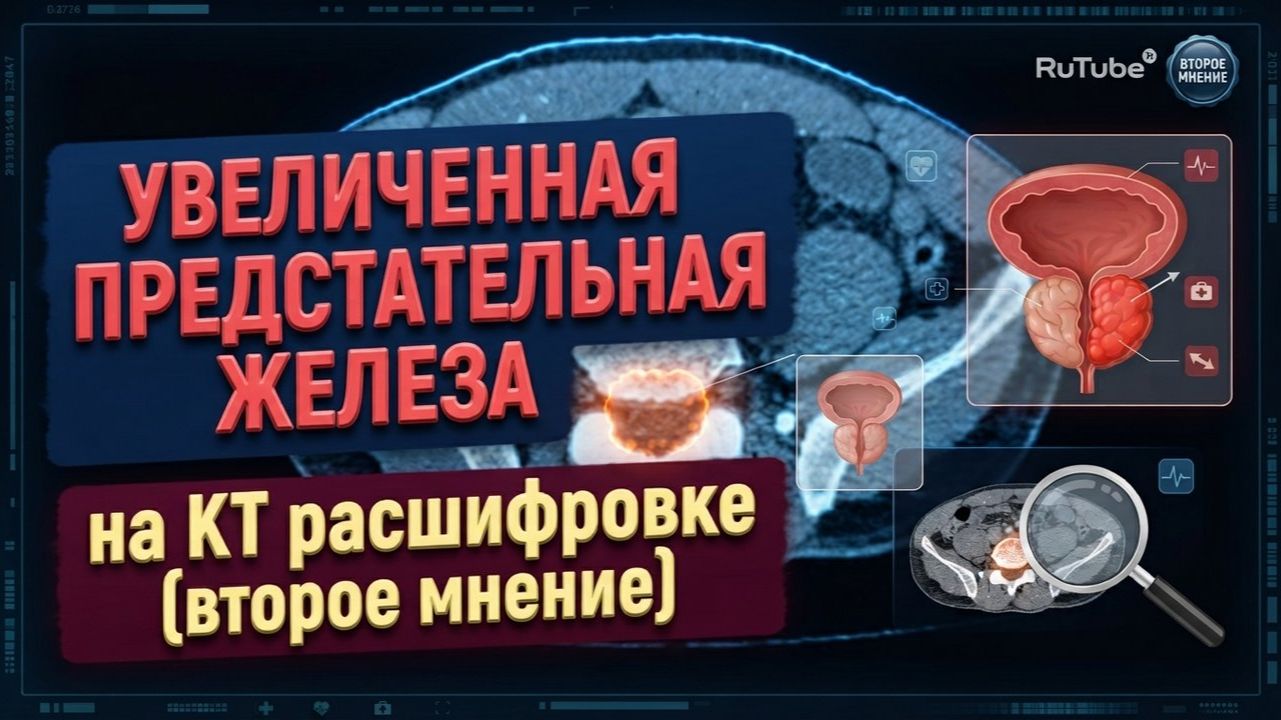 УВЕЛИЧЕНА предстательная железа как следствие ХРОНИЧЕСКОГО ПРОСТАТИТА на РАСШИФРОВКЕ КТ малого таза