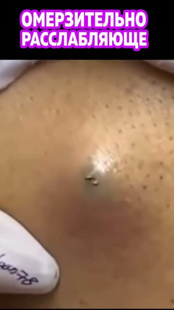 Выдавливание жирных прыщей