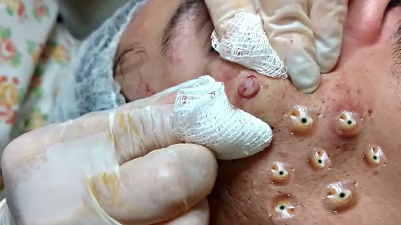 Relax squeezing out blackheads 43 Черные точки