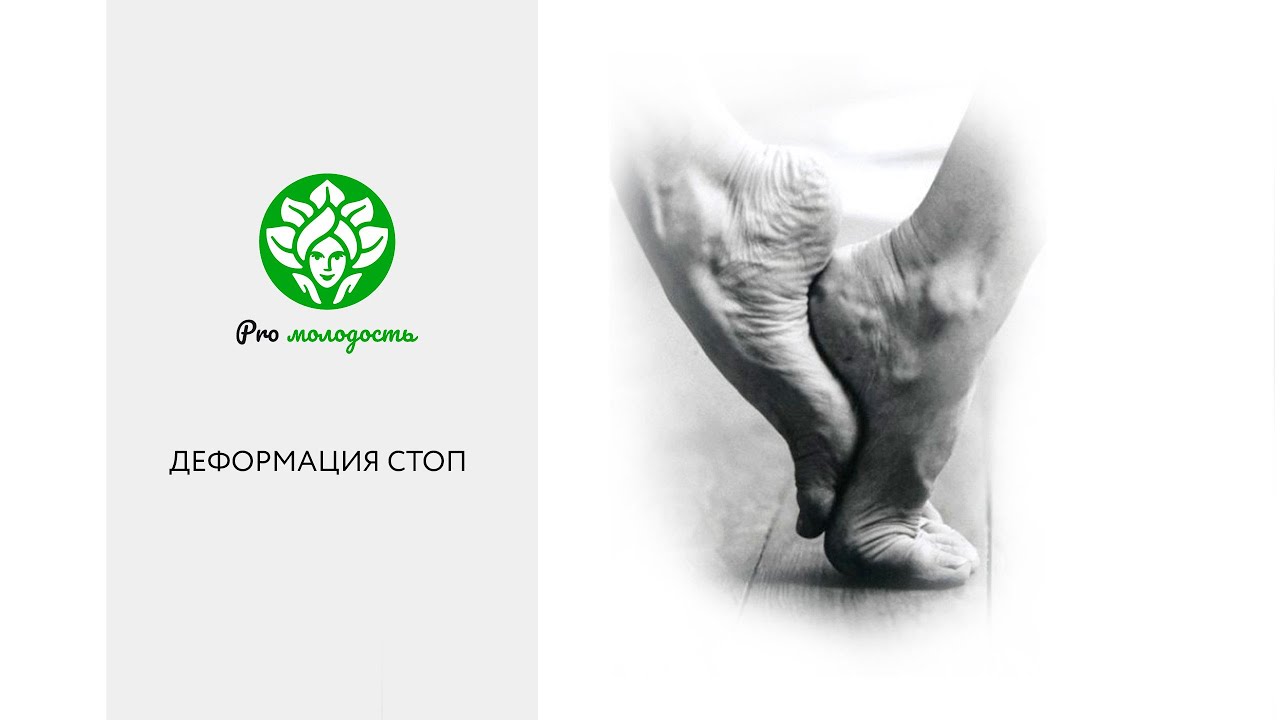 Деформация стоп - причины. Упражнение для красивых стоп.
